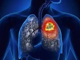 Người bị đá bóng bị đau ngực nhẹ cần chú ý các nguyên nhân không phải tim mạch