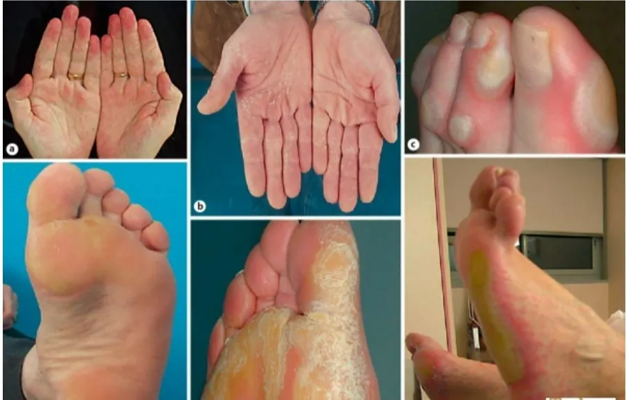 Biểu hiện trên da và móng của bệnh nhân trong quá trình điều trị hóa chất