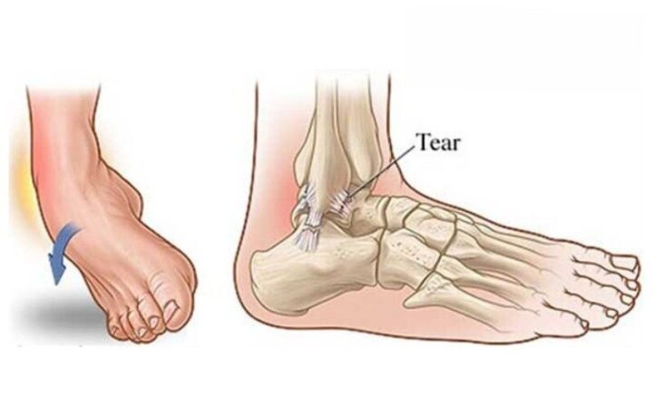 Lật Cổ Chân Khi Đá Bóng Cần Làm Gì: Hướng Dẫn Chi Tiết Và Toàn Diện Lật Cổ Chân Khi Đá Bóng Cần Làm Gì: Hướng Dẫn Chi Tiết Và Toàn Diện